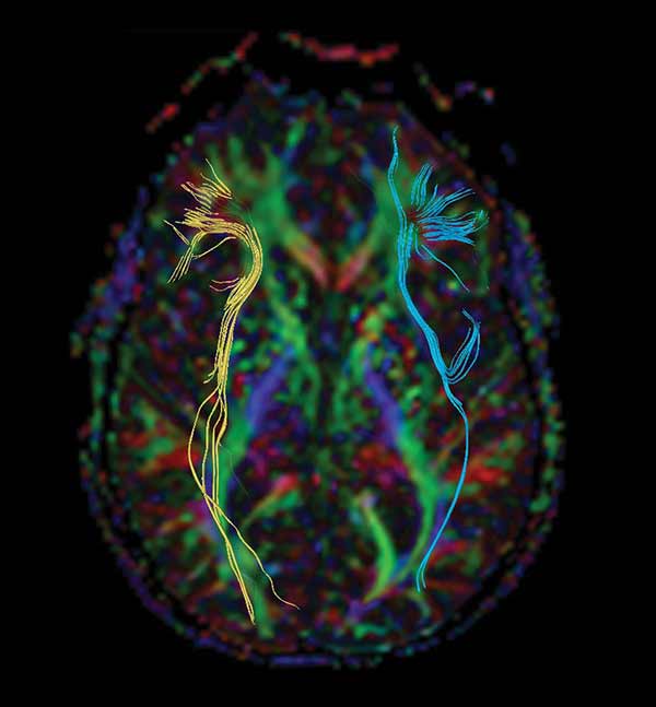 A computer-generated image of a brain